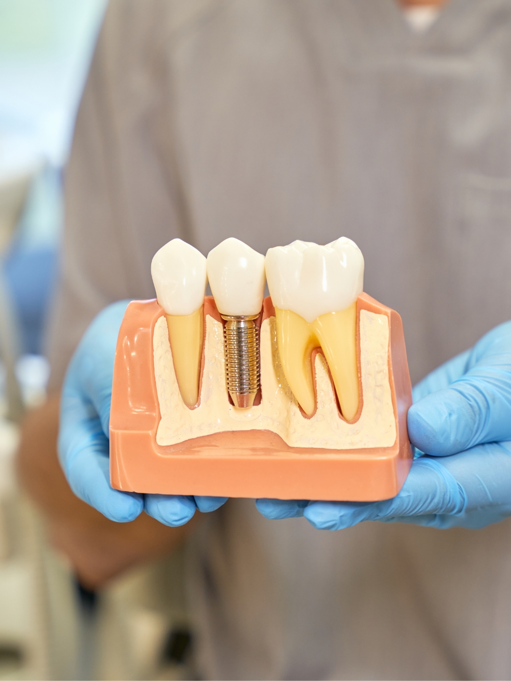 Dental Implant